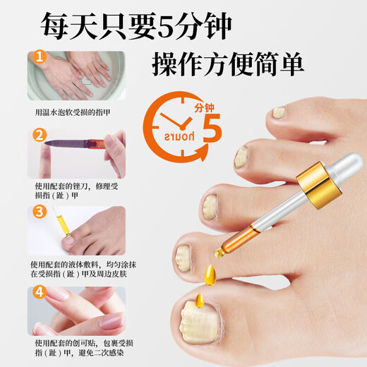 Guangyao Baiyunshan onychomycosis 100% special effect medicine No. 1 nail fungus infection removal onychomycosis root I treatment imported severe special effects in a box