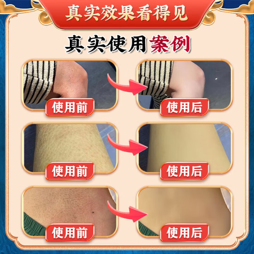 Hong Kong Pharmacy Fish Scale Skin Moisturizing Cream Snake Skin Leg Texture Special Hair Follicle Keratosis Peeling Skin Moisturizing Body Lotion Package 1 box (100g) Initial effect Fading lines