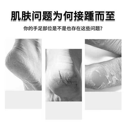 Yunnan Fungus King's Official Flagship Authentic Dry and Cracked Heels, Rough, Self-Starting, Hard Skin, Hand Openings, Dry and Cracked Anti-Cracking Cream, One Box, It Is Recommended to Take Multiple Bottles