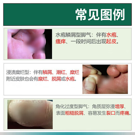 Yunnan herbal athlete's foot spray, anti-itching, peeling, rotten feet, fungal infection, blister, foot odor, sweat, antibacterial spray, 1 bottle - 60ml athlete's foot spray