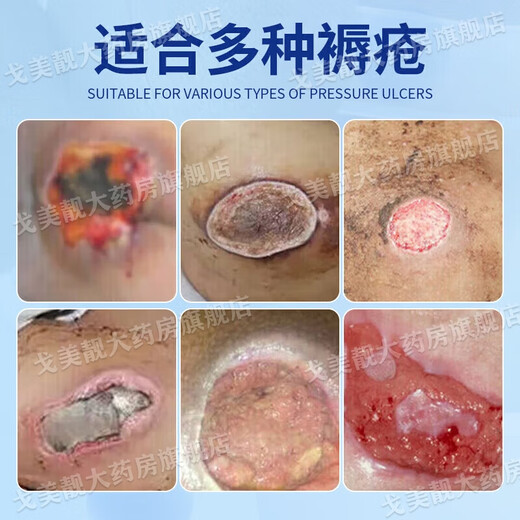 Special medicine for bedsores, bedsore ointment for external use on the buttocks of the elderly, bedsore ulcers and long-term bedridden skin ulcers medicine to promote wound healing, pressure sores, blisters, erythema, pain, muscle exposure, boric acid ointment 1 box, skin damage and ulceration, erythema and suppuration, multiple boxes recommended