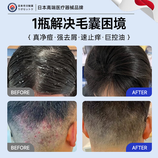 Jichuan Pharmaceutical Dankangwang Ketokang Hair Lotion Head Hair Follicle Seborrheic Dermatitis Special Anti-Dandruff Anti-Itching Oil Control Shampoo