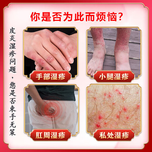 Peking Union Medical College, Japan imported eczema ointment Shiduqing skin itching dermatitis 100% fungal king infection to remove itching root special effect one box of ointment eczema itching package elimination stubborn eczema heat rash skin ringworm baby antibacterial anti-itching ointment