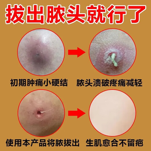 Mupirocin ointment, sebaceous cyst ointment, can be used to see the face, remove subcutaneous acne, powdery tumor hyperplasia, redness, inflammation, boils, poisonous pimples, pustules, anti-inflammation, treat pustules, poisonous boils, 2 boxes of red pimples and swelling on the body