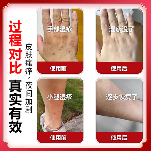 Peking Union Medical College, Japan imported eczema ointment Shiduqing skin itching dermatitis 100% fungal king infection to remove itching root special effect one box of ointment eczema itching package elimination stubborn eczema heat rash skin ringworm baby antibacterial anti-itching ointment