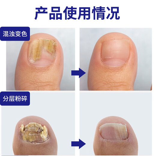 Bujiugang's special plaster for non-severe onychomycosis, nail fungal infection, non-imported onychomycosis, impatiens antibacterial liquid, onychomycosis liquid, newly upgraded, official authentic Japanese special effect onychomycosis liquid 1 box (mildly applicable)