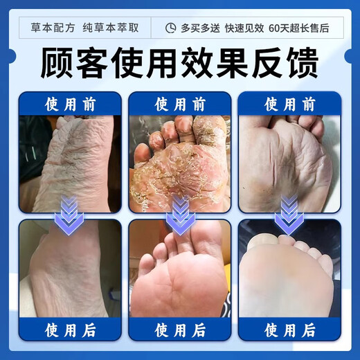 Beijing Tongrentang foot sweat and odor special anti-perspirant soak for athlete's foot and foot odor, special for excessive sweating, sore feet, athlete's foot, antiperspirant fungal infection spray, buy 2 get 1 free, 99% choice antiperspirant artifact