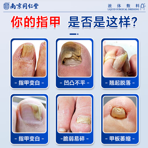 Tongrentang's 100% special medicine for treating severe onychomycosis, impatiens antibacterial liquid, fungal infection, 3 boxes of special onychomycosis liquid (severe can be cured)