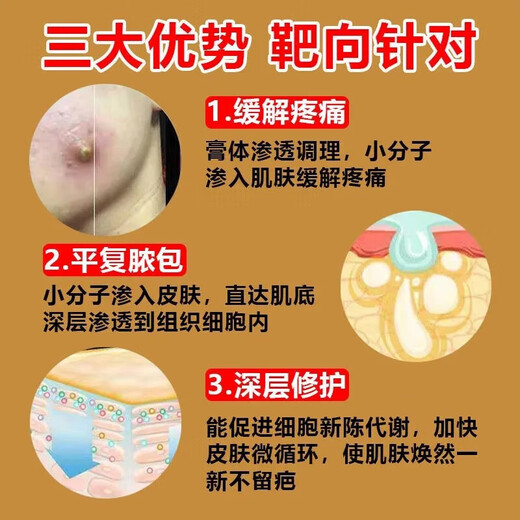 Mupirocin ointment, sebaceous cyst ointment, can be used to see the face, remove subcutaneous acne, powdery tumor hyperplasia, redness, inflammation, boils, poisonous pimples, pustules, anti-inflammation, treat pustules, poisonous boils, 2 boxes of red pimples and swelling on the body