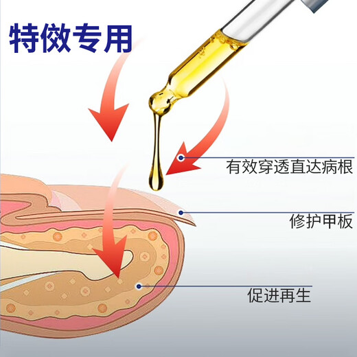 Bujiugang's special plaster for non-severe onychomycosis, nail fungal infection, non-imported onychomycosis, impatiens antibacterial liquid, onychomycosis liquid, newly upgraded, official authentic Japanese special effect onychomycosis liquid 1 box (mildly applicable)