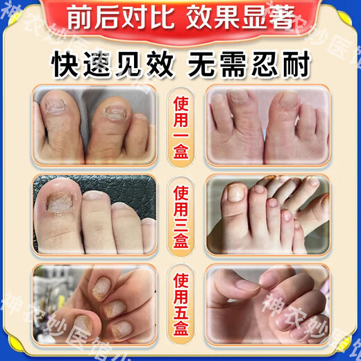 Akita Zeren's special medicine for onychomycosis, special nail fungus infection removal, bad nail brightening, root treatment, original imported from Japan, special effect, today's special offer, shoot 1 for 3, JD.com, what medicine is good for onychomycosis, fast, special ointment for onychomycosis room
