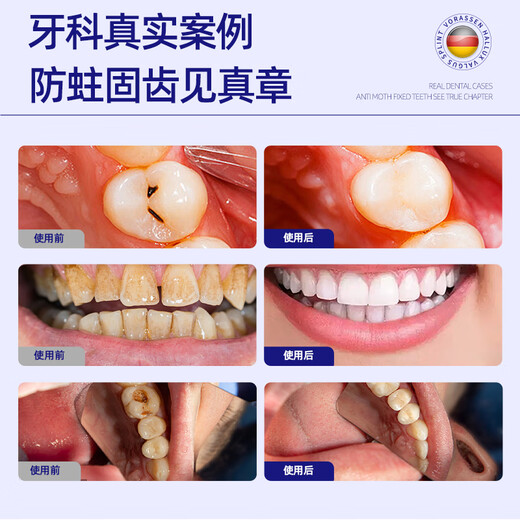 沃朗森医用含氟牙膏状成人防蛀脱敏蛀牙洞修复龋齿护龈固齿抗牙疼去口臭