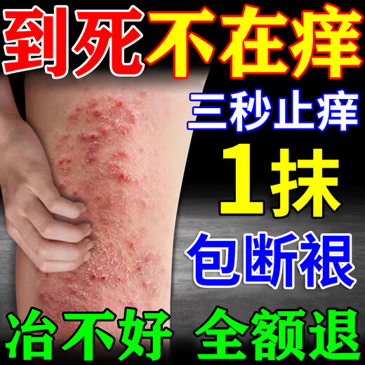 Peking Union Medical College, Japan imported eczema ointment Shiduqing skin itching dermatitis 100% fungal king infection to remove itching root special effect one box of ointment eczema itching package elimination stubborn eczema heat rash skin ringworm baby antibacterial anti-itching ointment