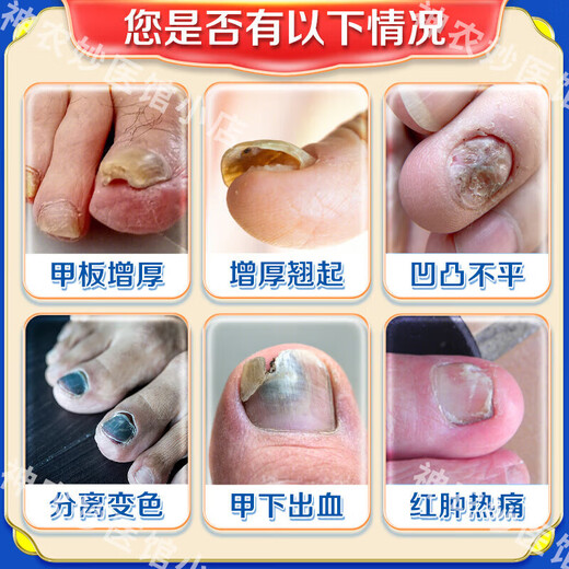 Akita Zeren's special medicine for onychomycosis, special nail fungus infection removal, bad nail brightening, root treatment, original imported from Japan, special effect, today's special offer, shoot 1 for 3, JD.com, what medicine is good for onychomycosis, fast, special ointment for onychomycosis room