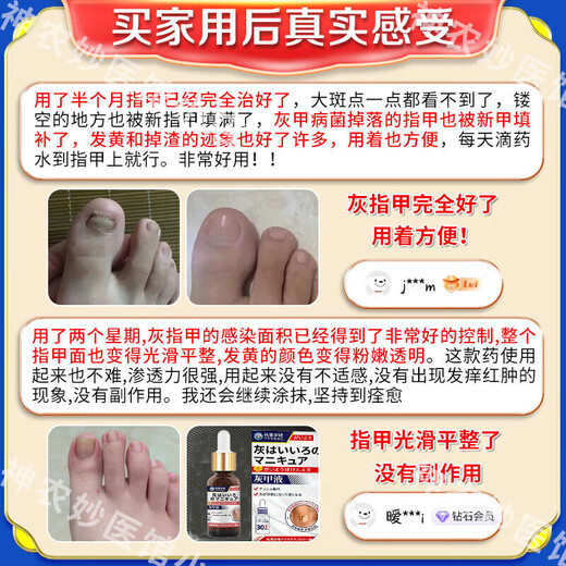 Akita Zeren's special medicine for onychomycosis, special nail fungus infection removal, bad nail brightening, root treatment, original imported from Japan, special effect, today's special offer, shoot 1 for 3, JD.com, what medicine is good for onychomycosis, fast, special ointment for onychomycosis room