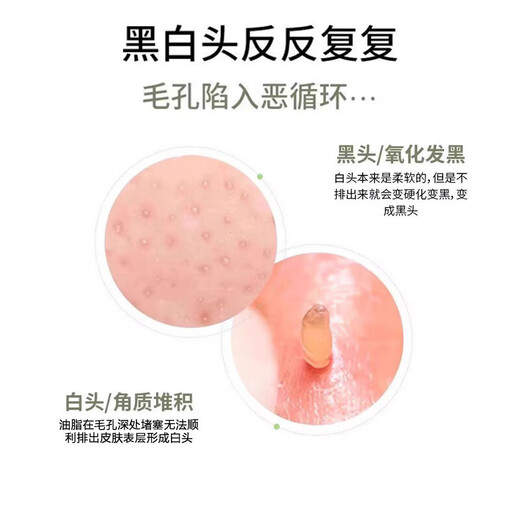 Scrape away blackheads. Portable blackhead scraper. Manual acne facial cleansing hair follicles and pores. Magic tool to remove blackheads. Scraper for face shaving. Small blackhead shovel. Portable. 1 pack - beauty spatula. Just scrape away + say goodbye to blackheads.