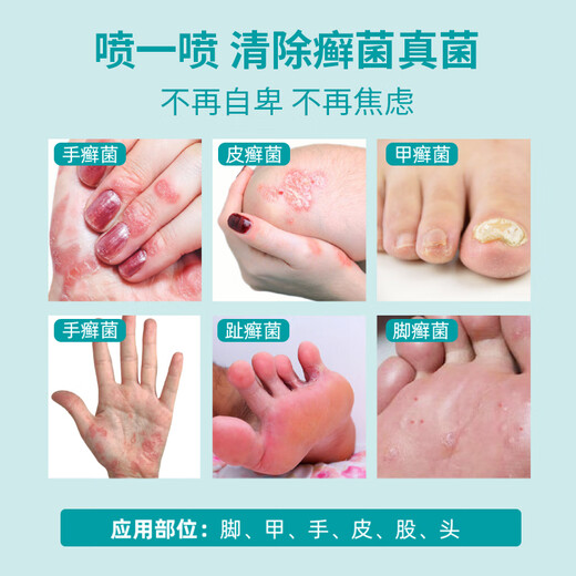 
99309930 Skin Disinfection Spray Spray Ash Disinfection Fungus Bacteria Itchy Pain Skin Infection 50ml/bottle 9930 Skin Disinfection Spray 50ml