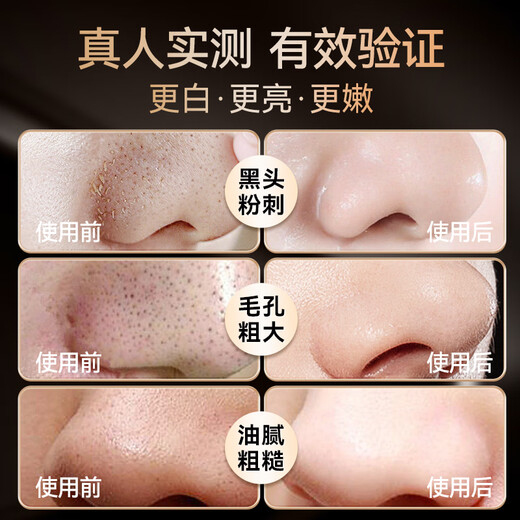 OES Blackhead Peeling Machine Ultrasonic Pore Cleaner Blackhead Instrument Artifact Facial Home Blackhead Remover Beauty Instrument Firming Mother's Day Gift Star Recommendations LCD Display + Ultrasonic Vibration + EMS Deep Firming