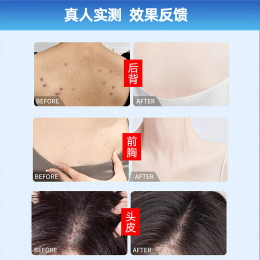 Gukanlin arm folliculitis red blood acne improves skin and scalp red rash pustules Get 2 boxes with discount