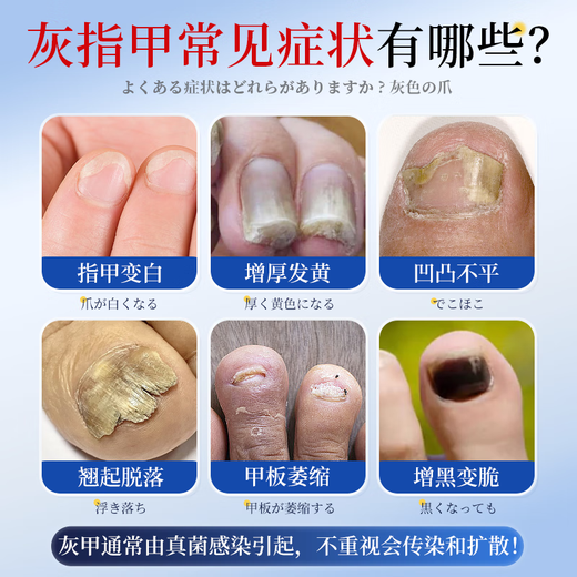 I-medicine for onychomycosis and severe antibacterial liquid. Fungal infection. Onychomycosis thickens, turns yellow, thickens and becomes empty. A box of onychomycosis cream. I-medicine for onychomycosis and onychomycosis. Jingdong Pharmacy