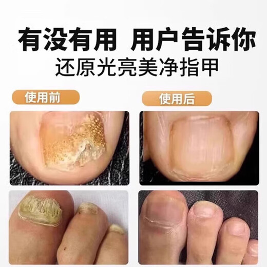 Mi Hong German electric nail clipper fully automatic hand and foot dual-use original nail polisher old man thick polisher gray trimming toenail white nail polisher shot 1 shot 6 4-speed adjustment to enhance horsepower