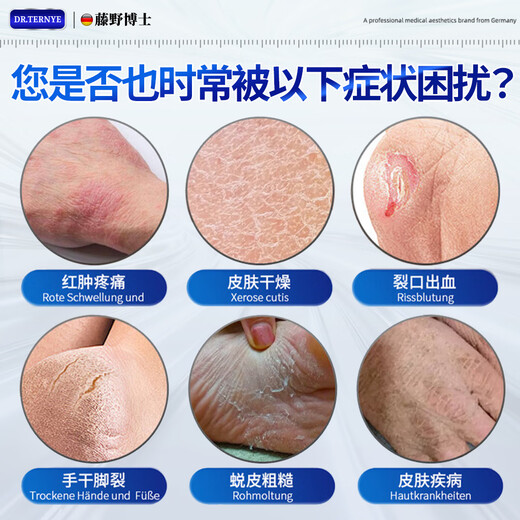 SIENORC Cracked Feet Cream for Cracked Heels, Cracked Heels, Cracked Heels, Cracked Heels, Foot Cream, Foot Cream 1 Box, Stay away from Cracked Hands and Feet on the same day