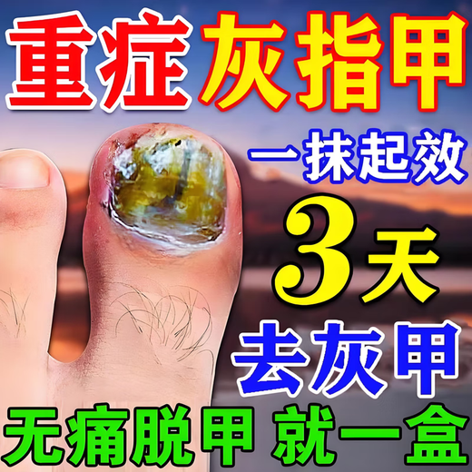 I-medicine for onychomycosis and severe antibacterial liquid. Fungal infection. Onychomycosis thickens, turns yellow, thickens and becomes empty. A box of onychomycosis cream. I-medicine for onychomycosis and onychomycosis. Jingdong Pharmacy