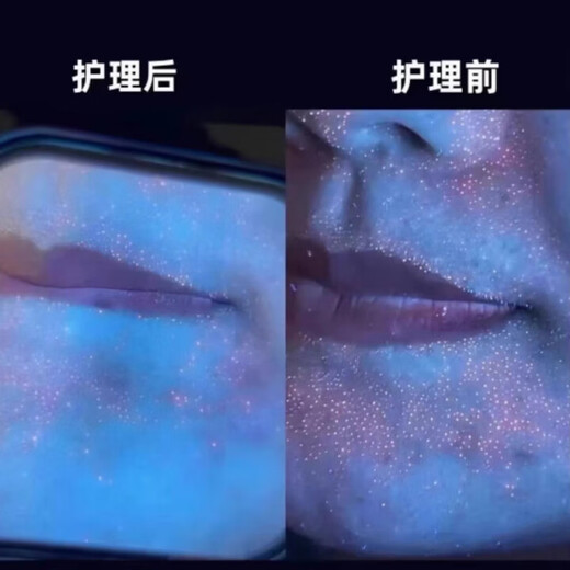 Skin detector, blackhead, acne and grease lamp, fungus and ringworm diagnosis, facial lighting, cosmetics, fluorescent flashlight, skin detection lamp, rechargeable 20W