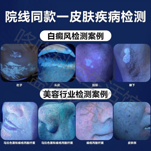 Skin detector, blackhead, acne and grease lamp, fungus and ringworm diagnosis, facial lighting, cosmetics, fluorescent flashlight, skin detection lamp, rechargeable 20W