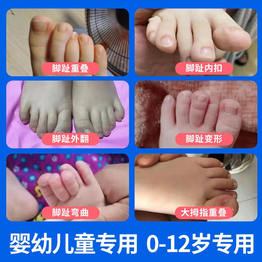 Baby and Children's Big Foot Toe Valgus et Backle Toe Correction Dispositif pour les enfants Toe à orteil curvé Splitter Yunan Yunfang Pharmacie Pharmacie (826) 1 à 8 ans White Five-Finger Toe Splitter / Deux paires les deux tailles