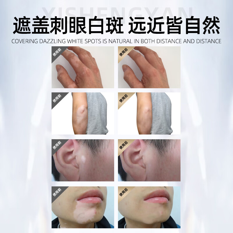 Xishengyan Whitening Epilepsy White Spot Covering Pen Long-lasting Waterproof and Sweat-proof Skin Color Cream External Concealer Liquid Magic Instant Waterproof Hot-Selling Model Total 2 Count (Hands, Feet, and Face)