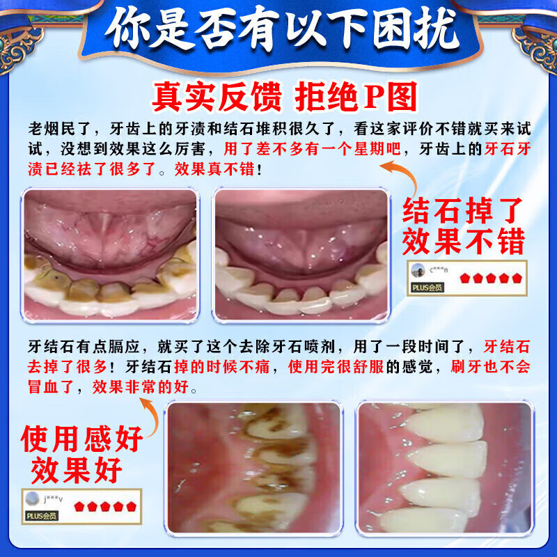 Hong Kong Pharmacy Dental Calculus Dissolving Liquid Teeth Cleaning and Yellowing Calculus Remover Tartar Calculus Removal Powerful Mouthwash 1 Bottle Quickly Improves Tartar