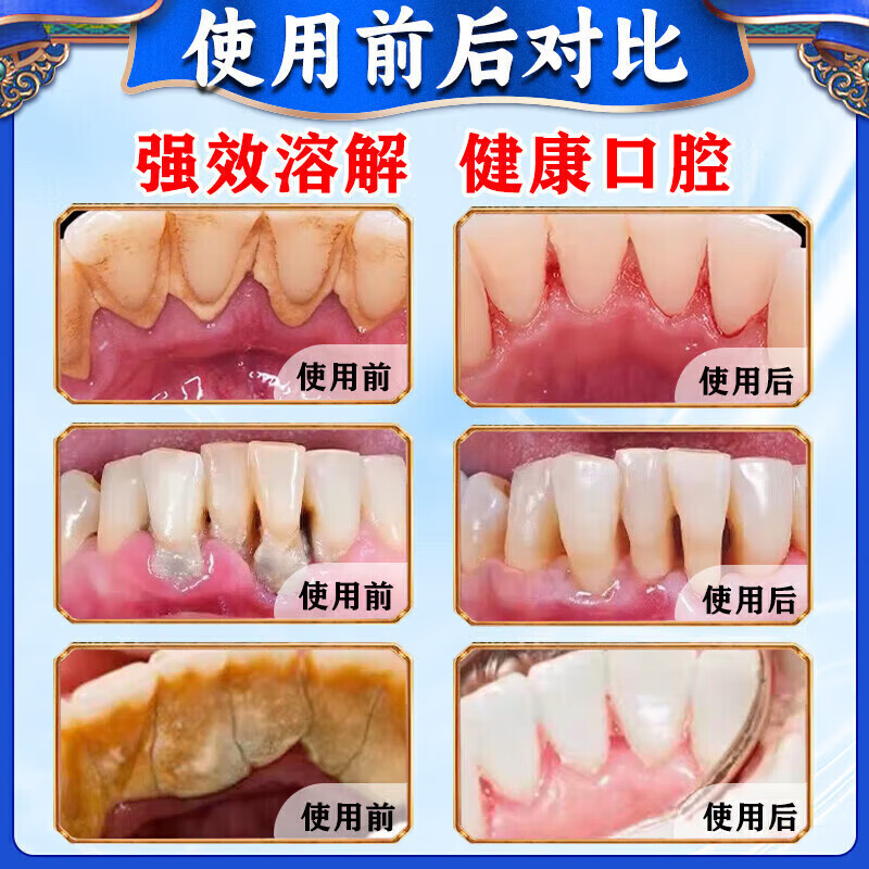 Hong Kong Pharmacy Dental Calculus Dissolving Liquid Teeth Cleaning and Yellowing Calculus Remover Tartar Calculus Removal Powerful Mouthwash 1 Bottle Quickly Improves Tartar