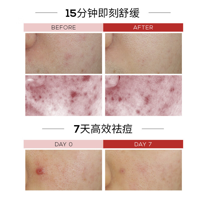 Purfu Yanping'an Repair Essence 30ml improves acne skin barrier, hydrates, moisturizes and controls oil New Year's gift