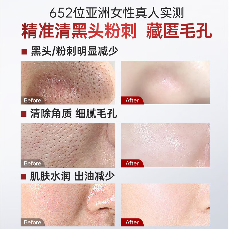 ZHENMI Singapore imported cleansing mud mask for deep cleaning, removing blackheads, shrinking pores, acne, closed mouth, hydrating and whitening mask