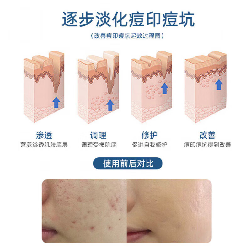 Aekz Repair Gel Medical Repair Genuine Sodium Hyaluronate Skin Repair Gel One Pack Official Flagship