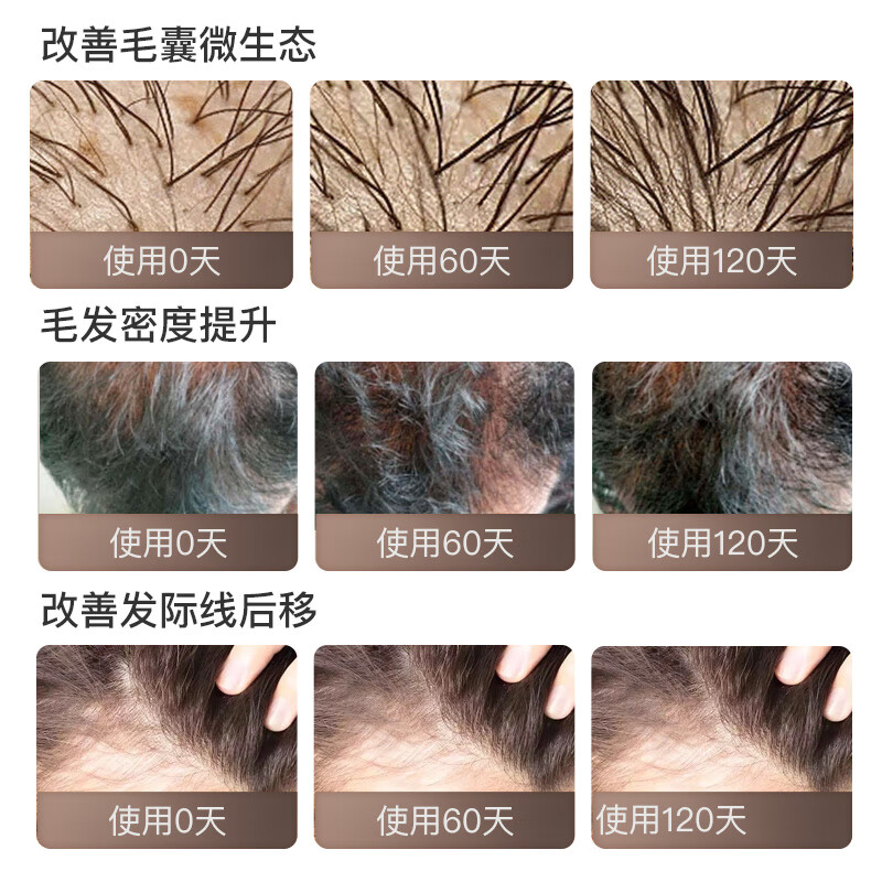 NatureU hair loss prevention hair care biotin saw palmetto unisex a-reductase caviar repair hair follicles anti-hair loss small black shield 6 bottles (repair hair follicles)