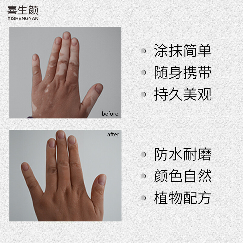 Xishengyan Whitening Epilepsy White Spot Covering Pen Long-lasting Waterproof and Sweat-proof Skin Color Cream External Concealer Liquid Magic Instant Waterproof Hot-Selling Model Total 2 Count (Hands, Feet, and Face)