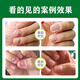 Correct onychomycosis antibacterial liquid, non-special effect, deck thickening and discoloration, nail groove fungal infection, impatiens sterilization and nail removal, 1 bottle of onychomycosis antibacterial liquid, mildly applicable