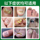 Correct onychomycosis antibacterial liquid, non-special effect, deck thickening and discoloration, nail groove fungal infection, impatiens sterilization and nail removal, 1 bottle of onychomycosis antibacterial liquid, mildly applicable