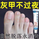 Empty, damaged, thickened and yellowed nails, herbal armor, severe onychomycosis, antiseptic liquid, brightening nail antibacterial ointment artifact 699+ Moderate