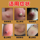 Mupirocin ointment, sebaceous cyst ointment, can be used to see the face, remove subcutaneous acne, powdery tumor hyperplasia, redness, inflammation, boils, poisonous pimples, pustules, anti-inflammation, treat pustules, poisonous boils, 2 boxes of red pimples and swelling on the body