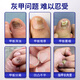 Bujiugang's special plaster for non-severe onychomycosis, nail fungal infection, non-imported onychomycosis, impatiens antibacterial liquid, onychomycosis liquid, newly upgraded, official authentic Japanese special effect onychomycosis liquid 1 box (mildly applicable)