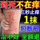 Peking Union Medical College, Japan imported eczema ointment Shiduqing skin itching dermatitis 100% fungal king infection to remove itching root special effect one box of ointment eczema itching package elimination stubborn eczema heat rash skin ringworm baby antibacterial anti-itching ointment