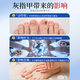 I-medicine for onychomycosis and severe antibacterial liquid. Fungal infection. Onychomycosis thickens, turns yellow, thickens and becomes empty. A box of onychomycosis cream. I-medicine for onychomycosis and onychomycosis. Jingdong Pharmacy