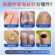 I-medicine for onychomycosis and severe antibacterial liquid. Fungal infection. Onychomycosis thickens, turns yellow, thickens and becomes empty. A box of onychomycosis cream. I-medicine for onychomycosis and onychomycosis. Jingdong Pharmacy