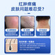 Gukanlin arm folliculitis red blood acne improves skin and scalp red rash pustules Get 2 boxes with discount