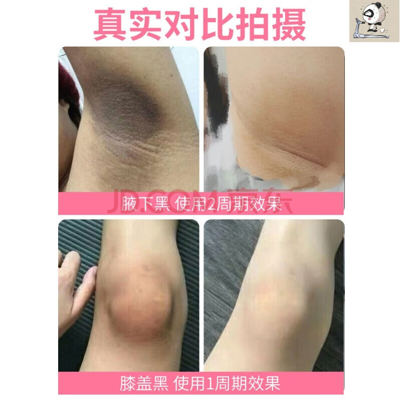 大腿內側去黑霜脖子黑頸部腋下臀部大腿根部去除黑色素沉澱私處淡化