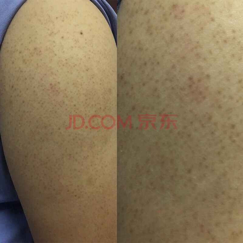 手臂黑黑的鸡皮肤怎么去除(脖子黑鸡皮肤怎么消除最有效) 手臂黑黑的鸡皮肤怎么去除(脖子黑鸡皮肤怎么消除最有效)