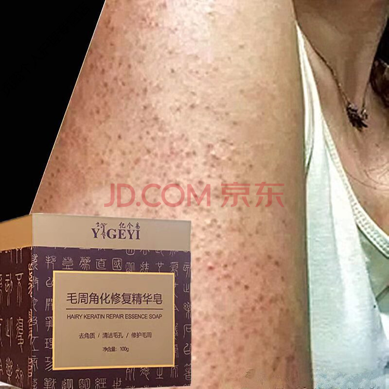 鸡皮疙瘩毛囊角质怎么去除(鸡皮疙瘩毛囊角质怎么去除图片)